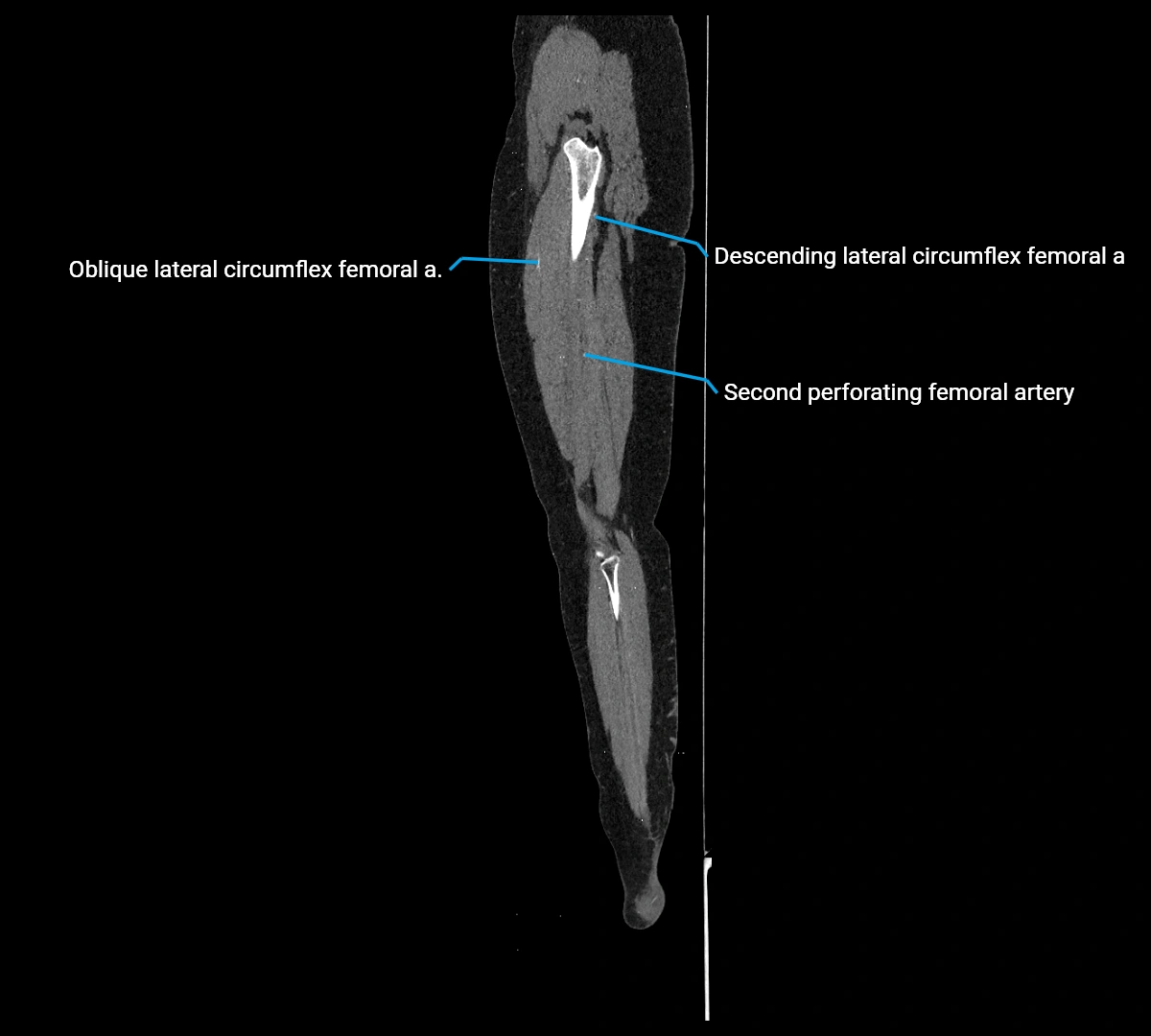 CTA lower limb sagittal cross sectional anatomy labelled image _60 (3).webp